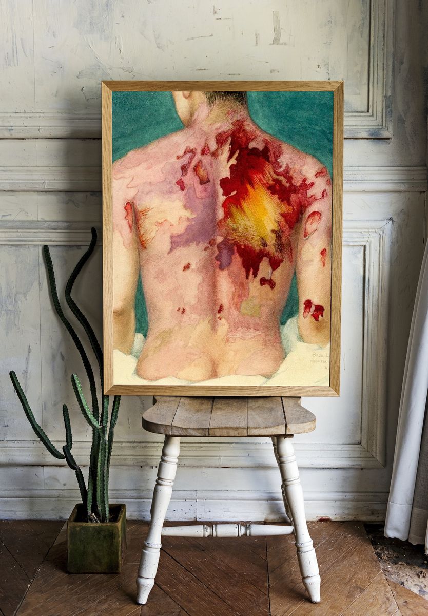 Watercolor painting mustard gas burns. — room view 1