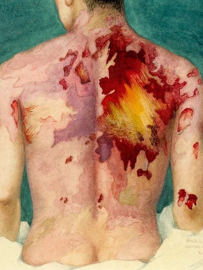 Watercolor painting mustard gas burns. poster
