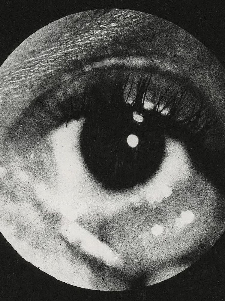 Clinical photograph cyst conjunctiva. Original. poster — fine-art art