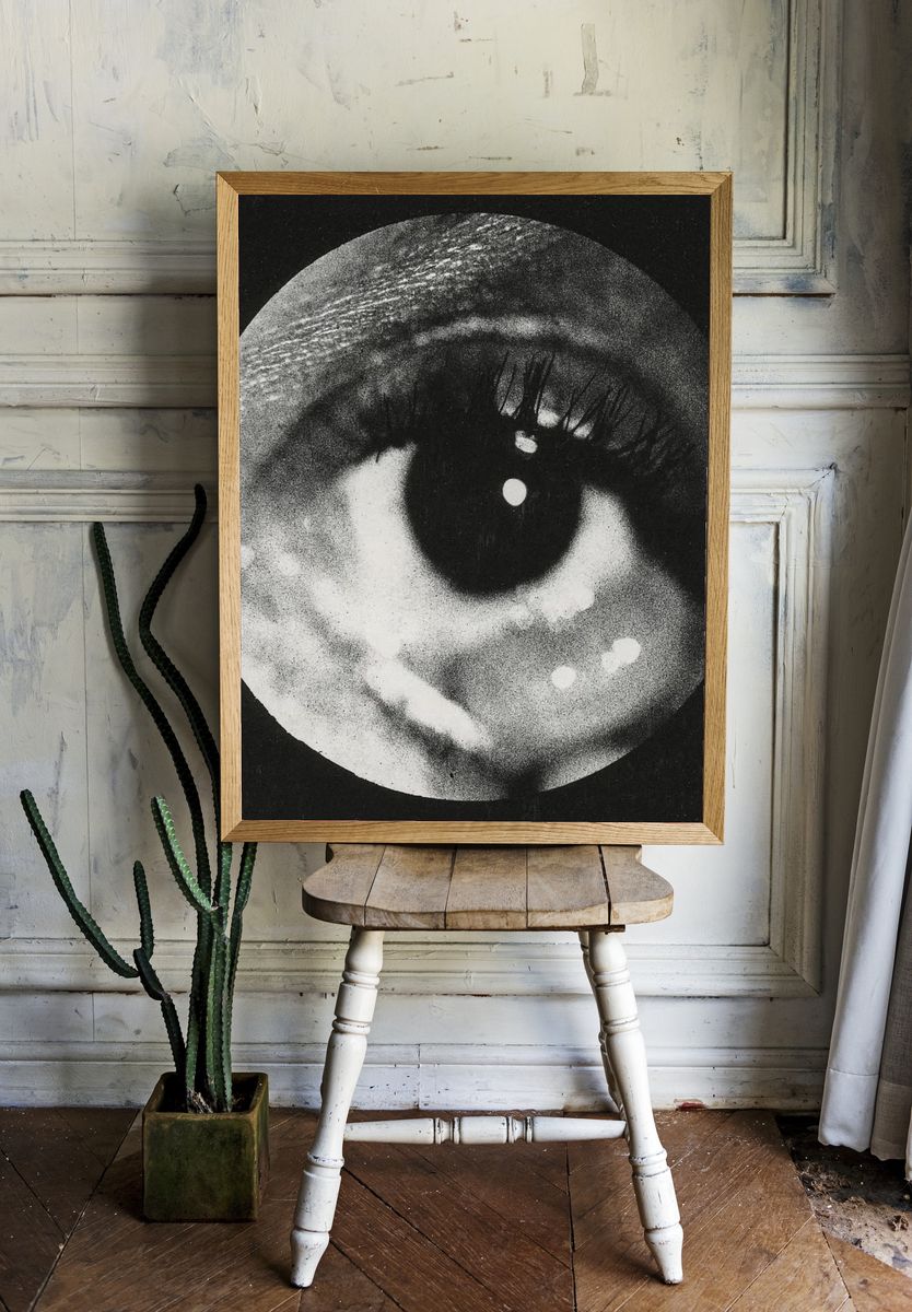 Clinical photograph cyst conjunctiva. Original. room preview