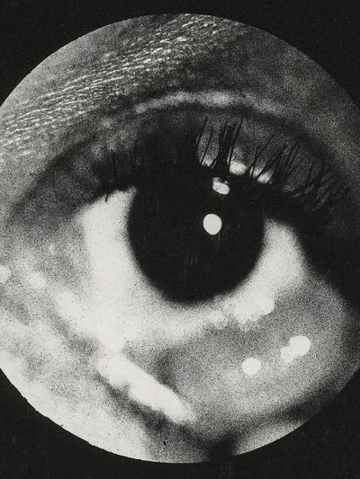 Clinical photograph cyst conjunctiva. Original. poster