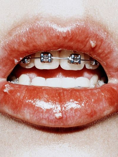 Braces Lips Close-Up Photography Poster. poster print