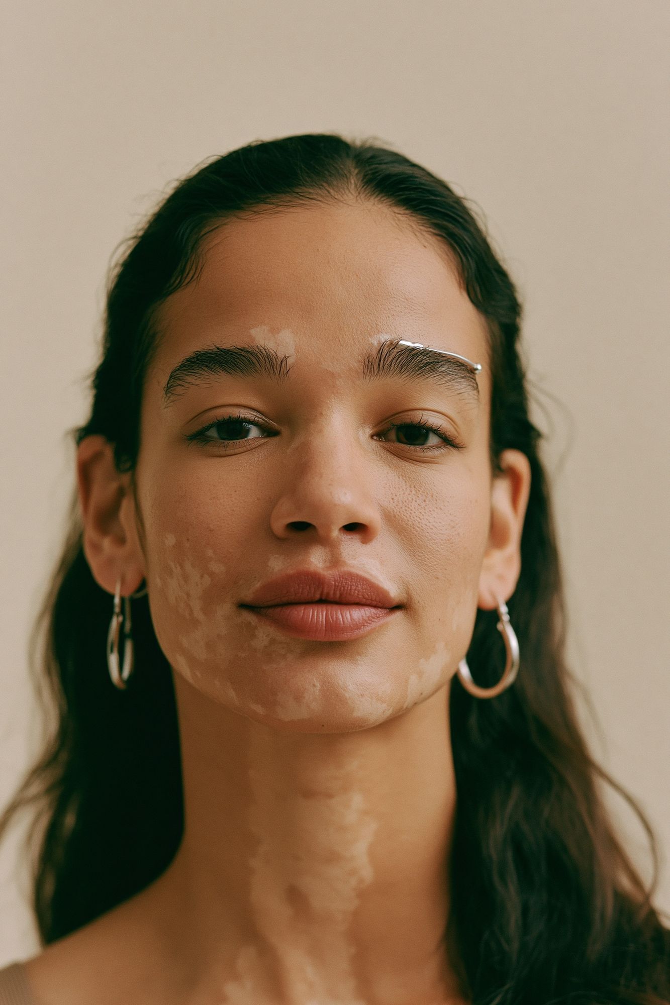 Portrait with Vitiligo Photography Poster. poster — photography art