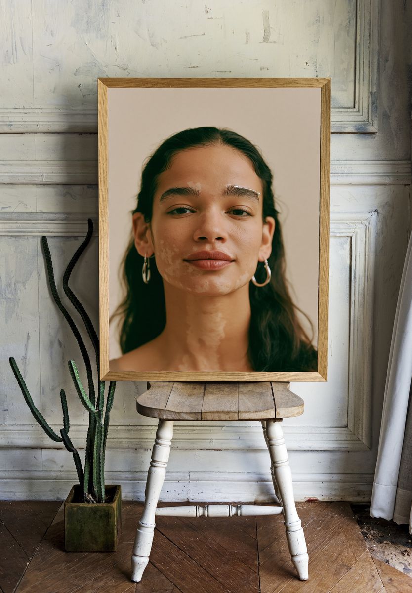 Portrait with Vitiligo Photography Poster. — room view 1